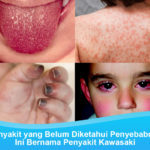 Penyakit Kawasaki