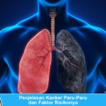 Kenali Kanker Paru-Paru dari Gejala dan Peneybabnya Berikut Ini Kanker Paru-paru