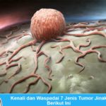Tumor jinak adalah