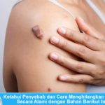 Penyebab dan cara menghilangkan keloid