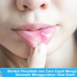 Cara mengobati sariawan dengan cepat
