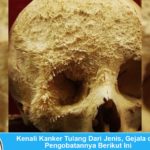 Jenis, gejala dan pengobatan kanker tulang