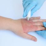 Mengatasi luka tersiram air panas agar tidak melepuh