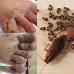 Benarkah Menginjak Kecoa Dapat Menyebabkan Infeksi Cacing di Kaki? Ini Faktanya! Bahaya cacing kecoa di balik kulit kaki karena tidak sengaja menginjak kecoa