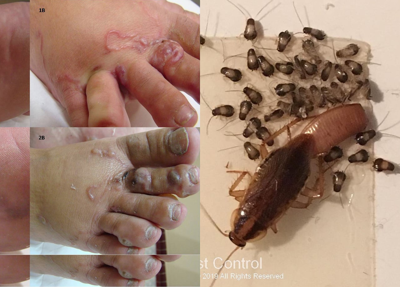 Bahaya cacing kecoa di balik kulit kaki karena tidak sengaja menginjak kecoa