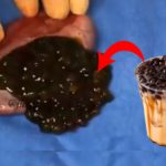 Boba di dalam kantung empedu