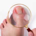 Cara ampuh Mencegah dan mengobati cantengan