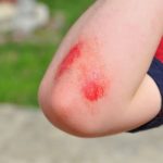 Cara mengobati luka lecet