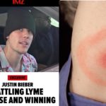 Justin Bieber Menderita Penyakit Lyme Akibat Gigitan Kutu Satu Ini Justin Bieber menderita penyakit Lyme
