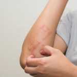 Ketahui Eksim dari Jenis, Penyebab, Gejala dan Pengobatan Berikut Ini Ketahui Eksim dari Jenis, Penyebab, Gejala dan Pengobatannya Berikut Ini