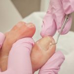 Cantengan: Penyebab, Gejala, Pengobatan dan Perawatan Secara Tepat Cara mengobati cantengan secara tepat dan ampuh