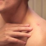 Bisul: Jenis, Penyebab, Gejala, Pengobatan dan Pencegahan Bisul: Jenis, Penyebab, Gejala, Pengobatan dan Pencegahan