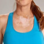 Panu - Penyebab, Gejala, Pengobatan dan Pencegahan