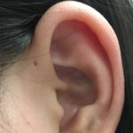Sinus Preauricular: Penyebab, Gejala, Pengobatan dan Perawatan Sinus Preauricular adalah lubang kecil di telinga