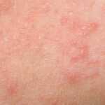 Kudis: Penyebab, Gejala, Pengobatan, dan Pencegahan Kudis: Penyebab, Gejala, Pengobatan, dan Pencegahan