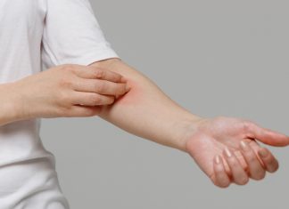 Kenali Perbedaan Ruam Kulit Biasa dan Ruam HIV, Jangan Keliru!