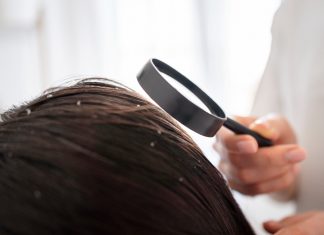 Mengenal Scalp Psoriasis, Penyakit Kulit yang Mirip Ketombe