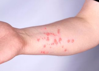 Cacar Air Ternyata dapat Menyerang Lansia, Benarkah?