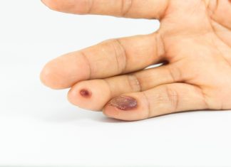 Muncul Mata Ikan di Bagian Tangan? Kenali Penyebab Hingga Cara Penangannya