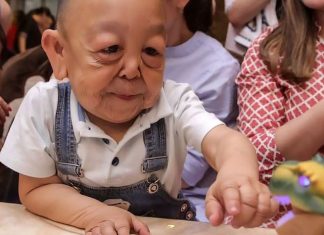 Mengenal Progeria, Penyakit Langka yang Bikin Wajah Anak Tua Seperti Lansia