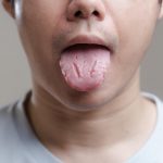 Lidah Terbakar Usai Minum Air panas? Jangan Panik, Begini Cara Mengatasinya