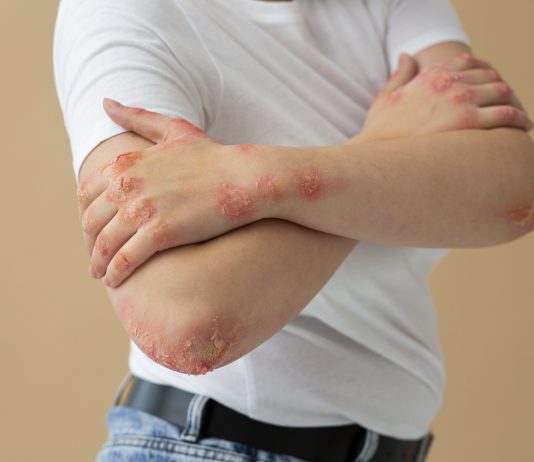 Kenali 10 Pilihan Obat Alami (Tradisional) yang Efektif Atasi Kurap, Patut Dicoba!