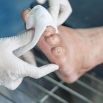 Layanan Jasa Perawatan Luka Diabetes yang Tepat, Cepat dan Profesional jasa perawatan luka diabetes