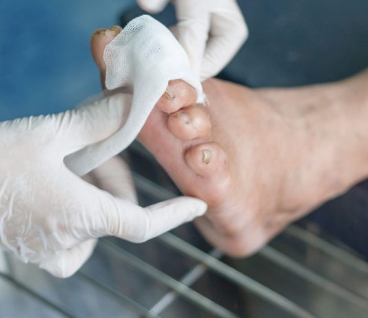 jasa perawatan luka diabetes