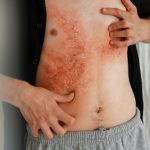 7 Jenis Penyakit Kulit Menular: Kenali Penyebab dan Gejalanya