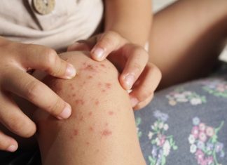 Pahami Perbedaan Mpox dan Biduran: Gejala, Penyebab, dan Pengobatan